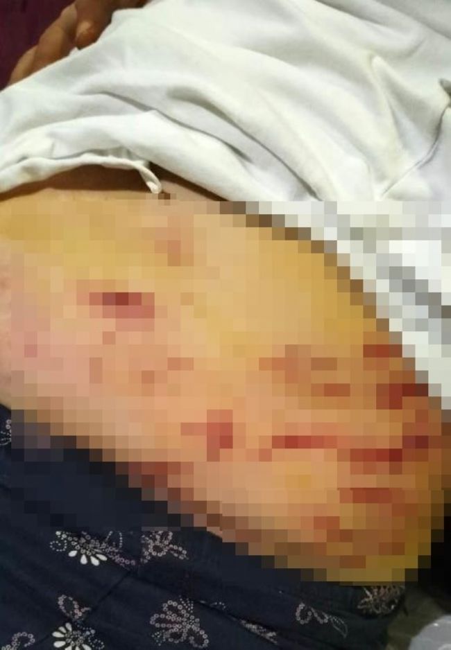 Köpeğin ısırdığı anne yaşananları anlattı